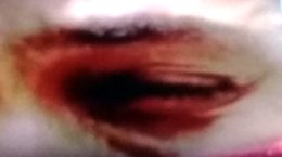 ब्लैक फंगस या म्यूकोर्मिकोसिस