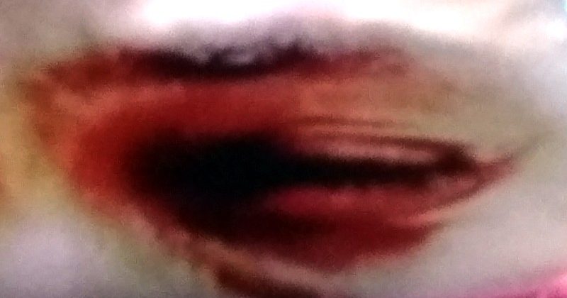 ब्लैक फंगस या म्यूकोर्मिकोसिस