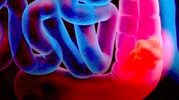 Bowel cancer cases rise among young people in Europe