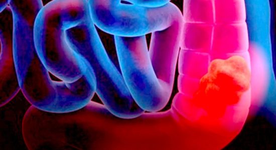 Bowel cancer cases rise among young people in Europe