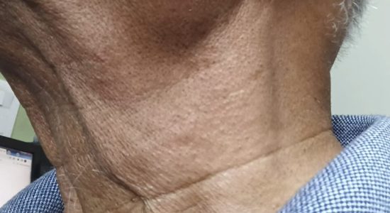 Sore throat and neck pain—causes, relationship and treatment