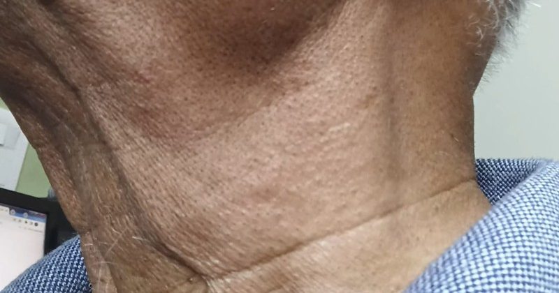 Sore throat and neck pain—causes, relationship and treatment