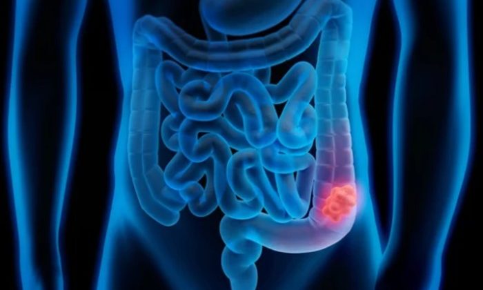 Combo therapy may reduce cancer mortality by 50%