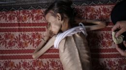 Nine-year-old Palestinian girl, weighing 10 kilograms