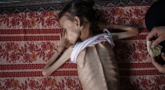 Nine-year-old Palestinian girl, weighing 10 kilograms