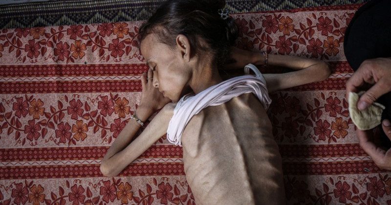 Nine-year-old Palestinian girl, weighing 10 kilograms